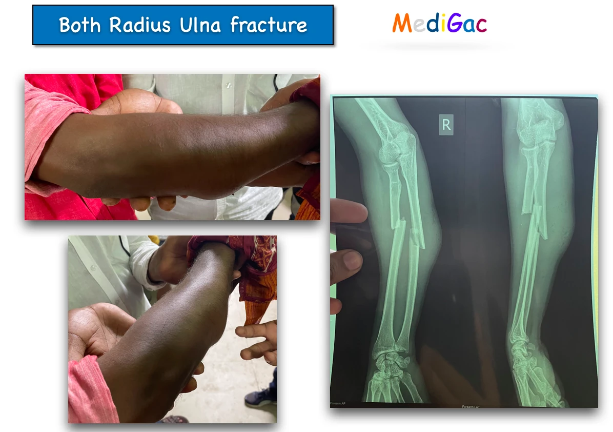 Both radius and ulna fracture